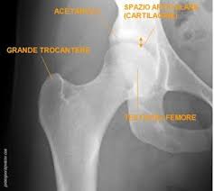 La frattura del femore la più frequente tra gli incidenti ...